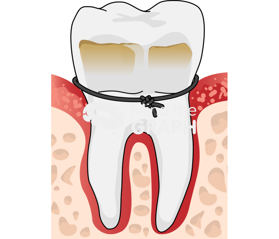 Ligature induced periodontitis Icons, Symbols, Pictures, and Images