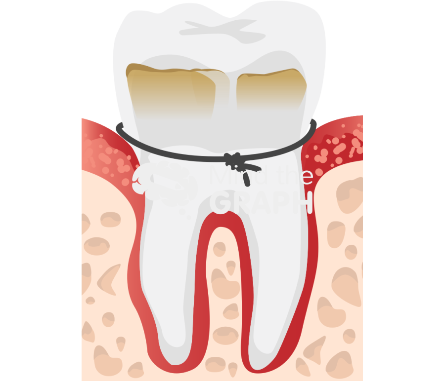 Ligature induced periodontitis Icons, Symbols, Pictures, and Images