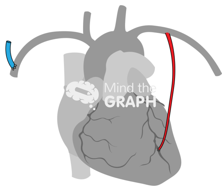 Light internal mammary artery contralateral arteriovenous fistula 2 Icons, Symbols, Pictures, and Images