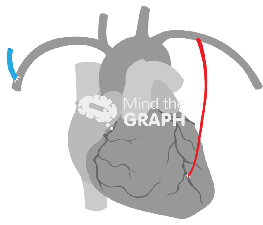 Light internal mammary artery contralateral arteriovenous fistula 2 Icons, Symbols, Pictures, and Images