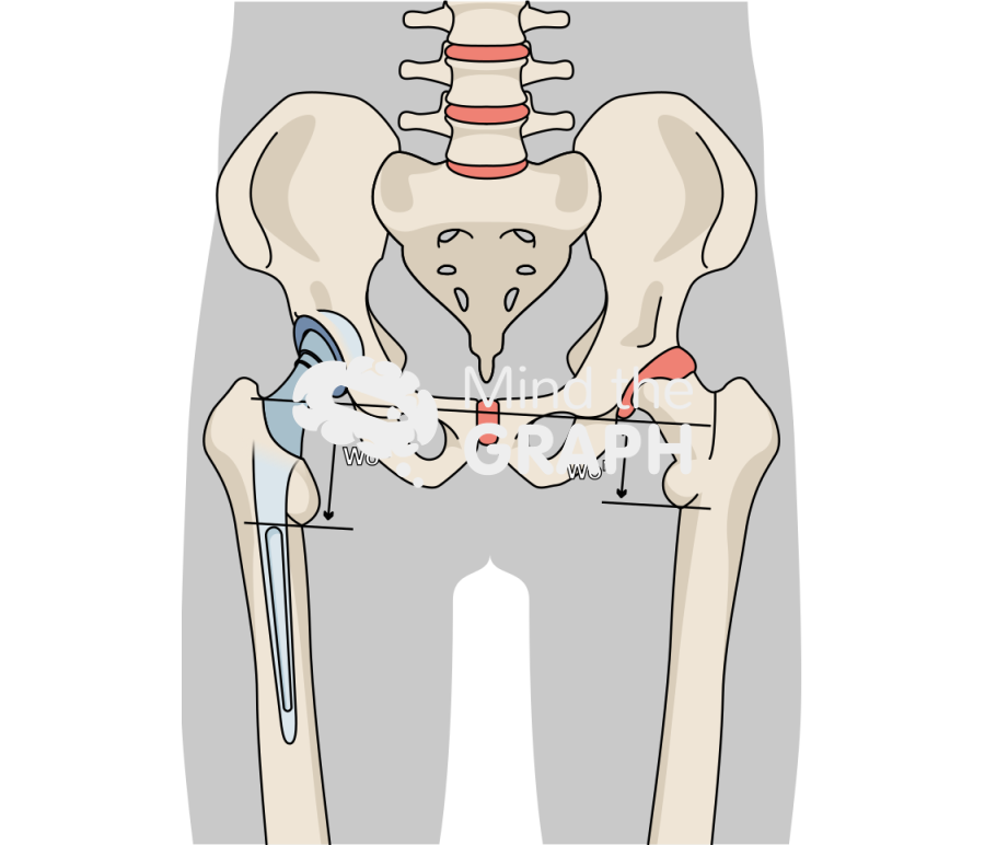 Limb length discrepancy total hip arthroplasty body Icons, Symbols, Pictures, and Images