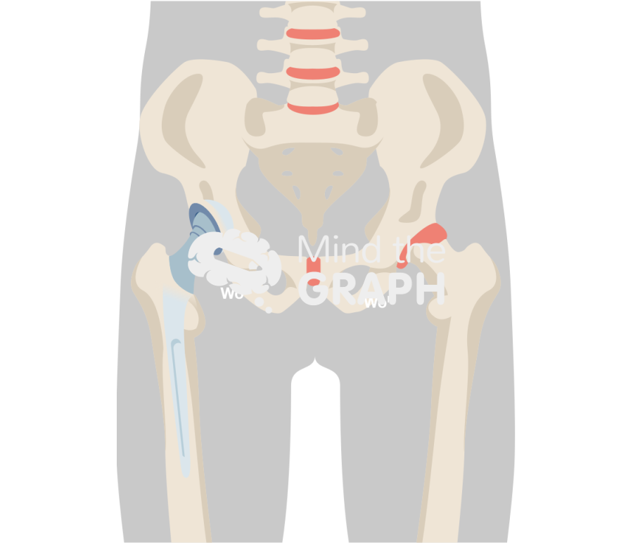 Limb length discrepancy total hip arthroplasty body Icons, Symbols, Pictures, and Images