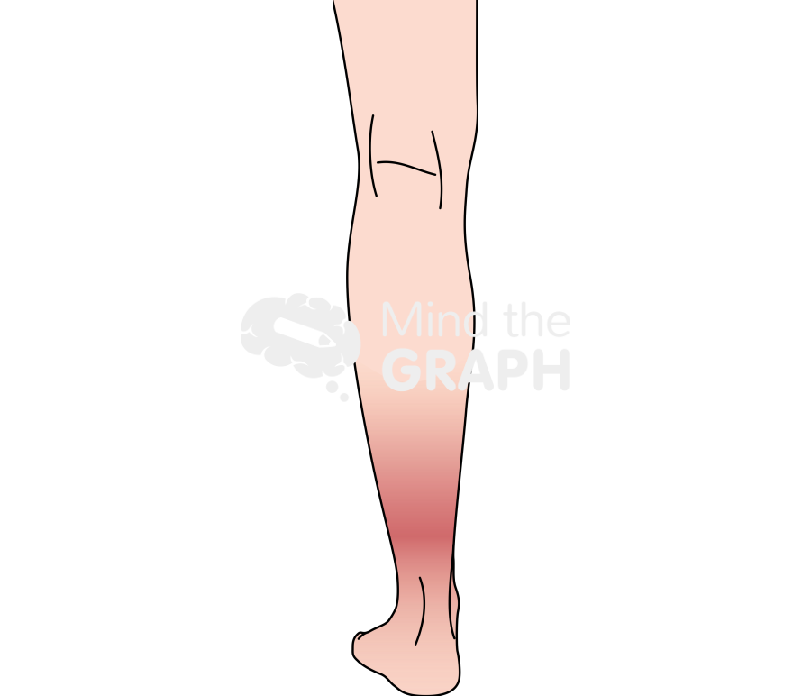 Lipodermatosclerosis Icons, Symbols, Pictures, and Images