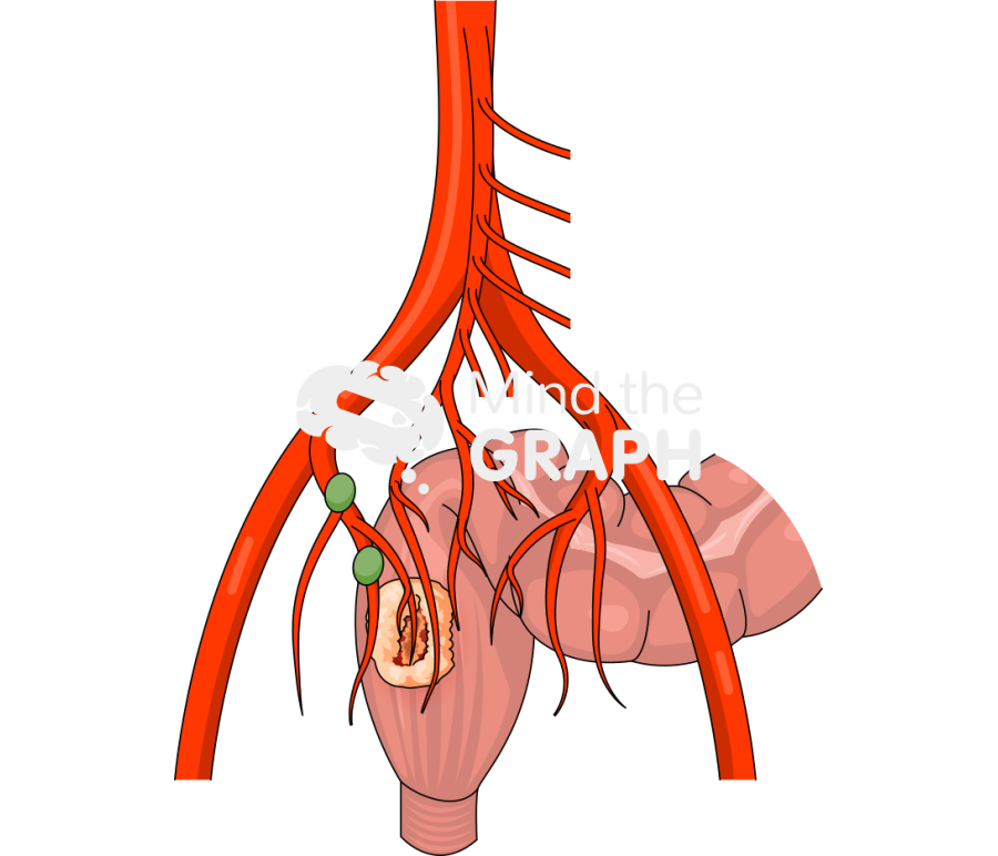 Lower rectal cancer lateral lymph nodes Icons, Symbols, Pictures, and Images
