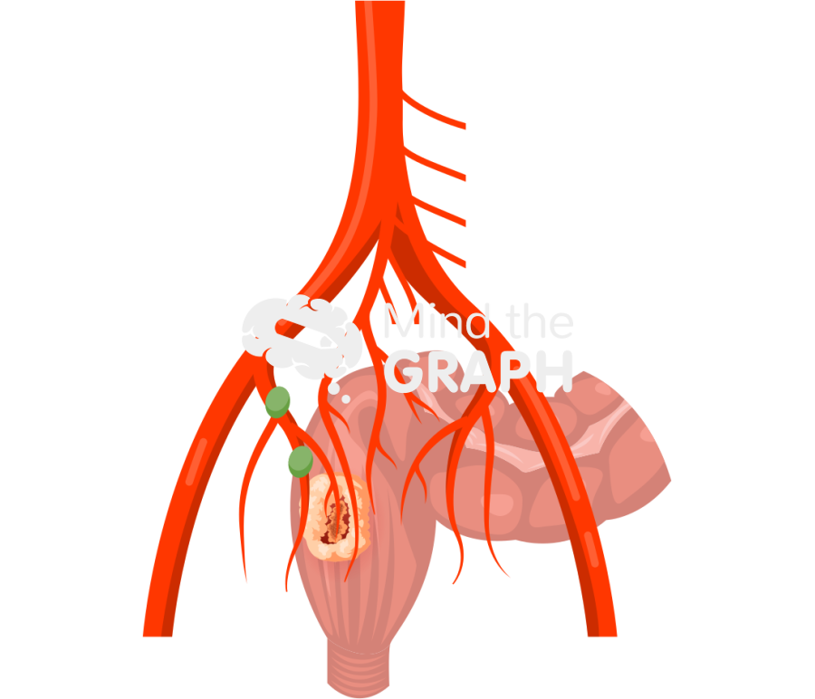 Lower rectal cancer lateral lymph nodes Icons, Symbols, Pictures, and Images