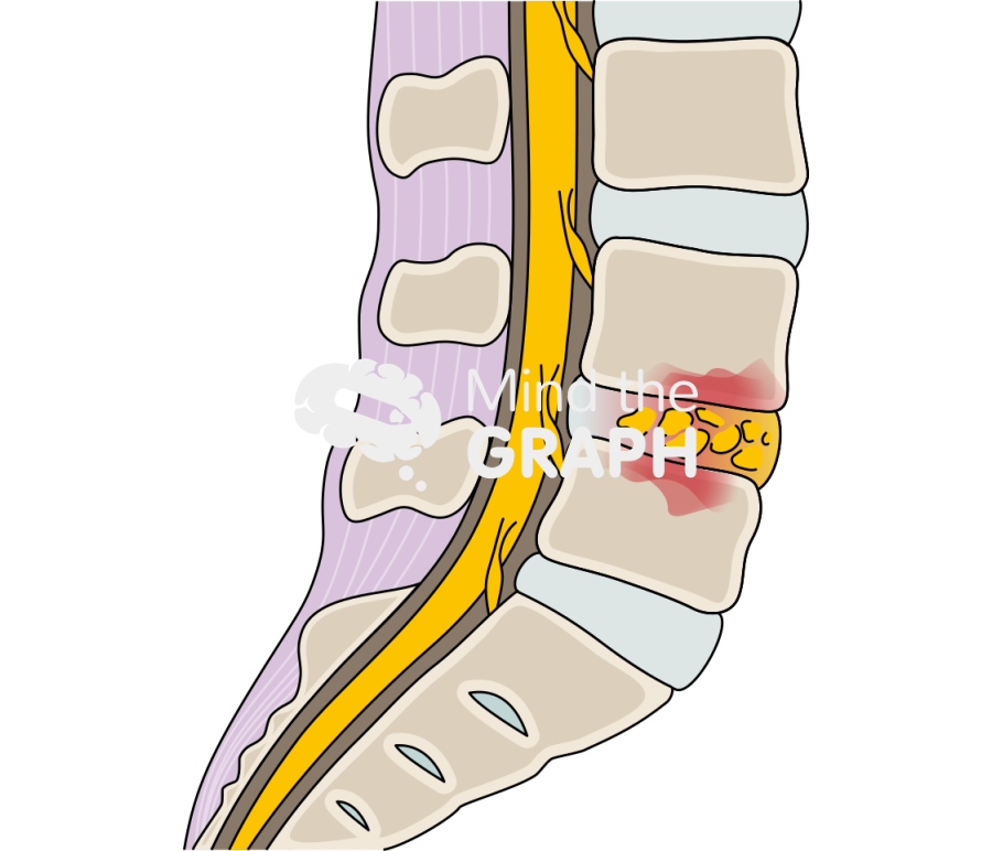 Lumbar spondylodiscitis lateral Icons, Symbols, Pictures, and Images