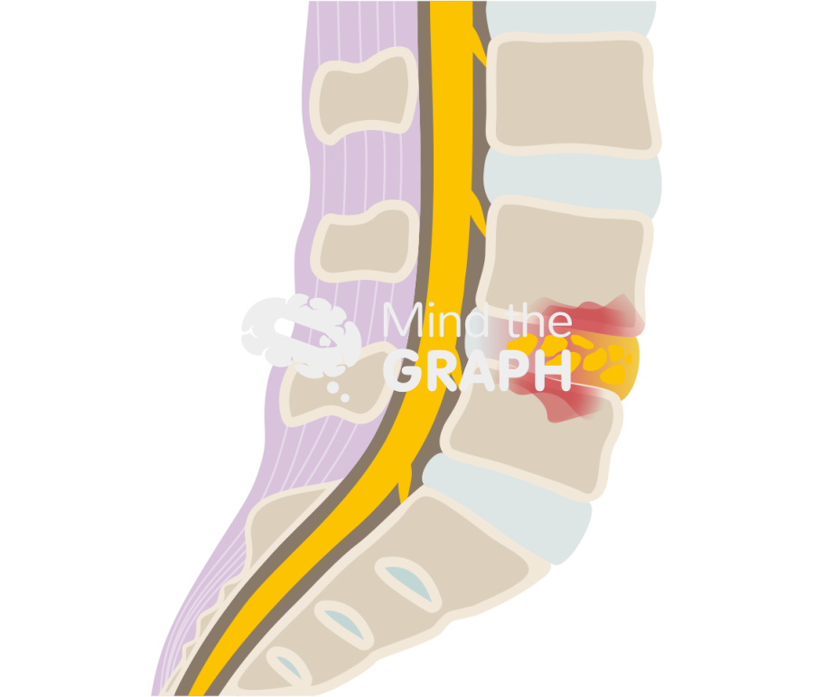 Lumbar spondylodiscitis lateral Icons, Symbols, Pictures, and Images