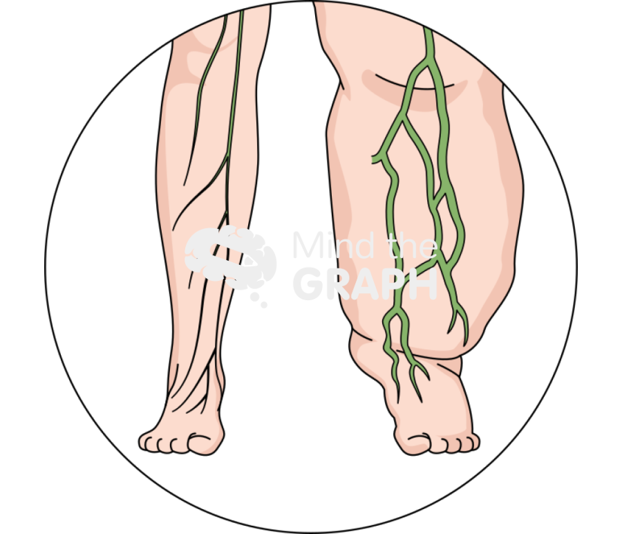 Lymphedema lymphatic system zoom Icons, Symbols, Pictures, and Images