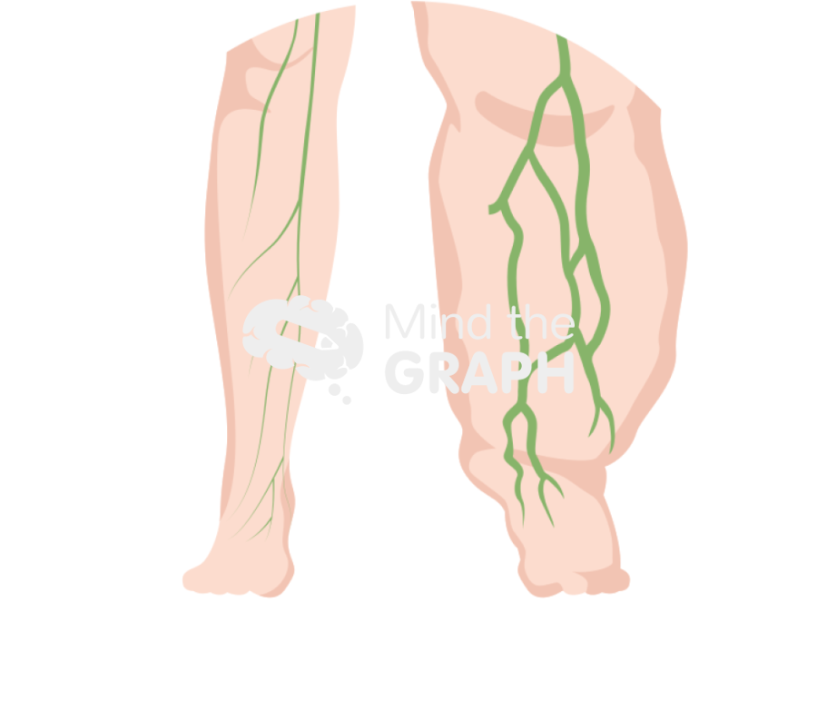 Lymphedema lymphatic system zoom Icons, Symbols, Pictures, and Images