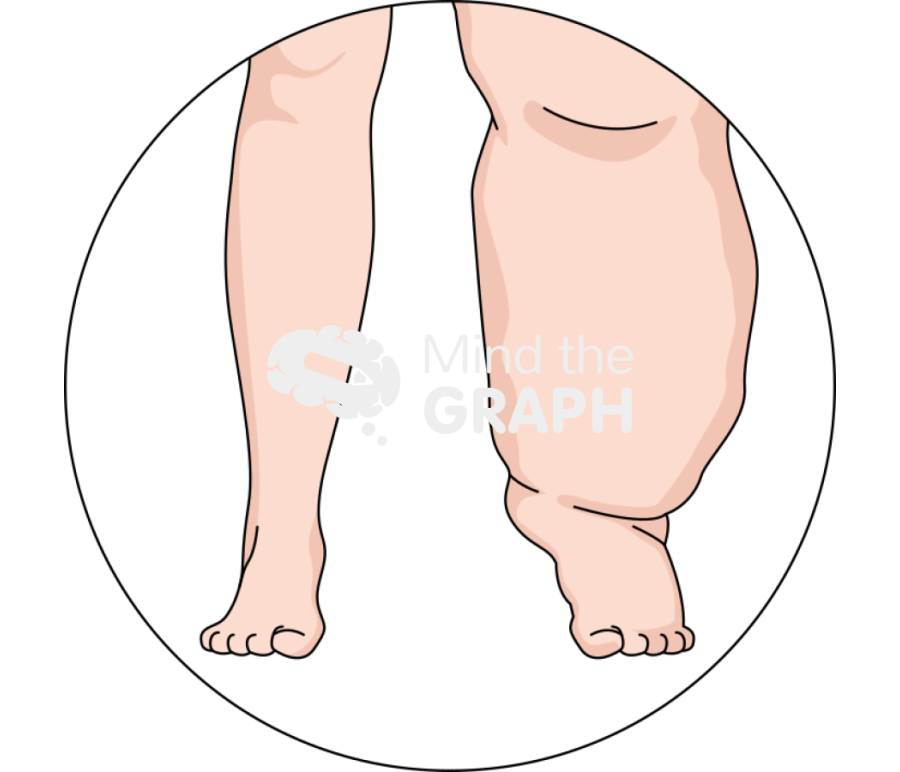 Lymphedema zoom Icons, Symbols, Pictures, and Images