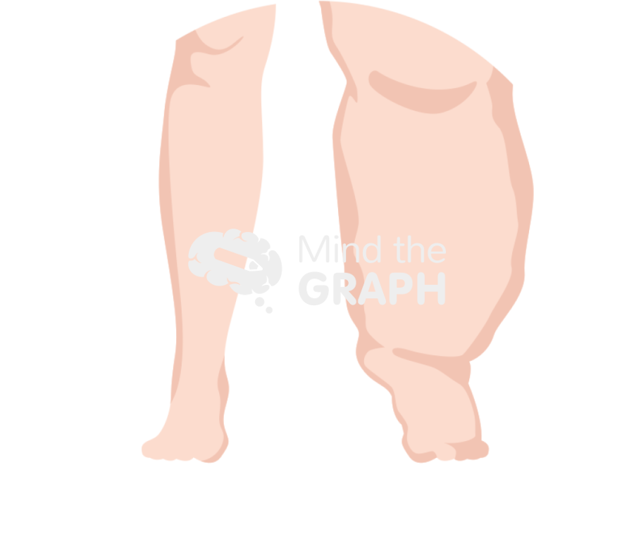 Lymphedema zoom Icons, Symbols, Pictures, and Images