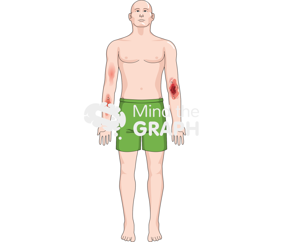 Man burn wound Icons, Symbols, Pictures, and Images