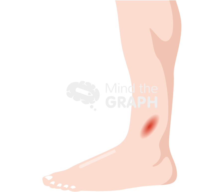 Man leg cellulitis side Icons, Symbols, Pictures, and Images