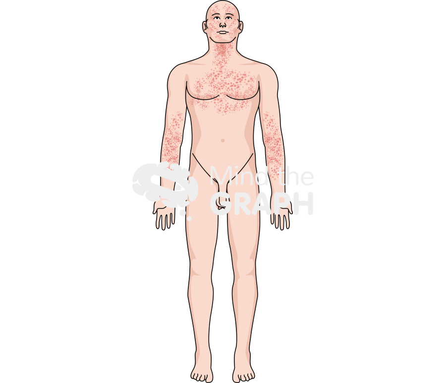 Man malassezia folliculitis front Icons, Symbols, Pictures, and Images