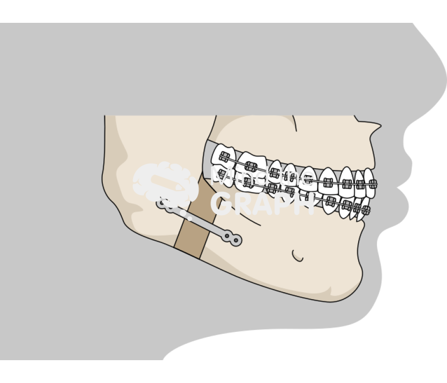 Mandibular deficiency and orthognathic surgery 2 Icons, Symbols, Pictures, and Images