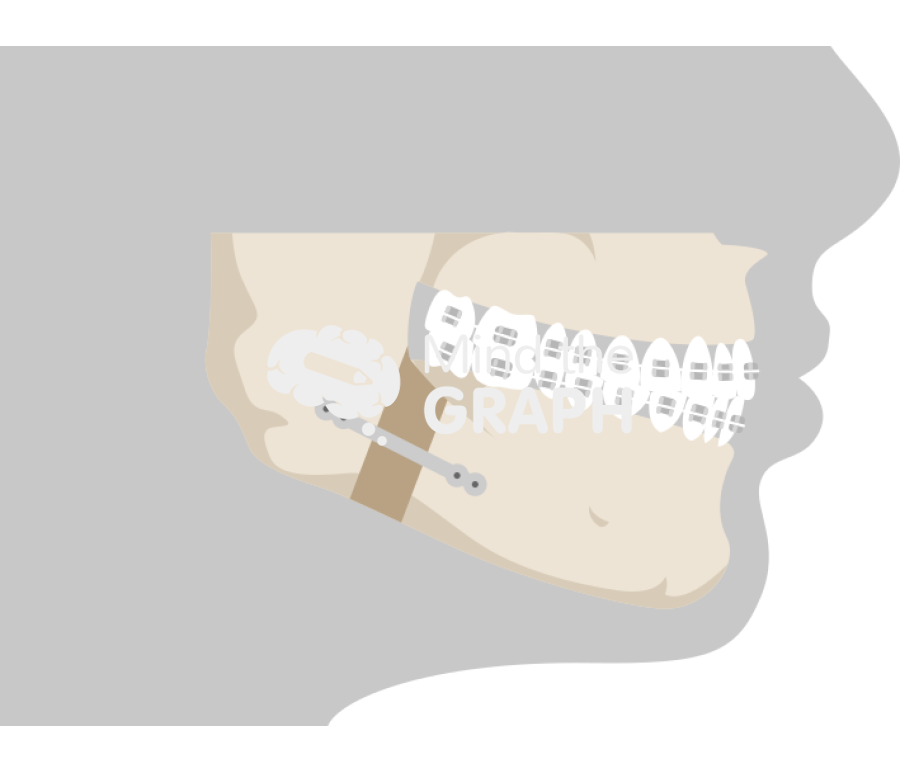 Mandibular deficiency and orthognathic surgery 2 Icons, Symbols, Pictures, and Images