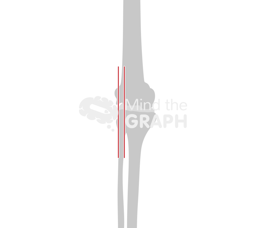 Medial tibiofemoral subluxation bone Icons, Symbols, Pictures, and Images