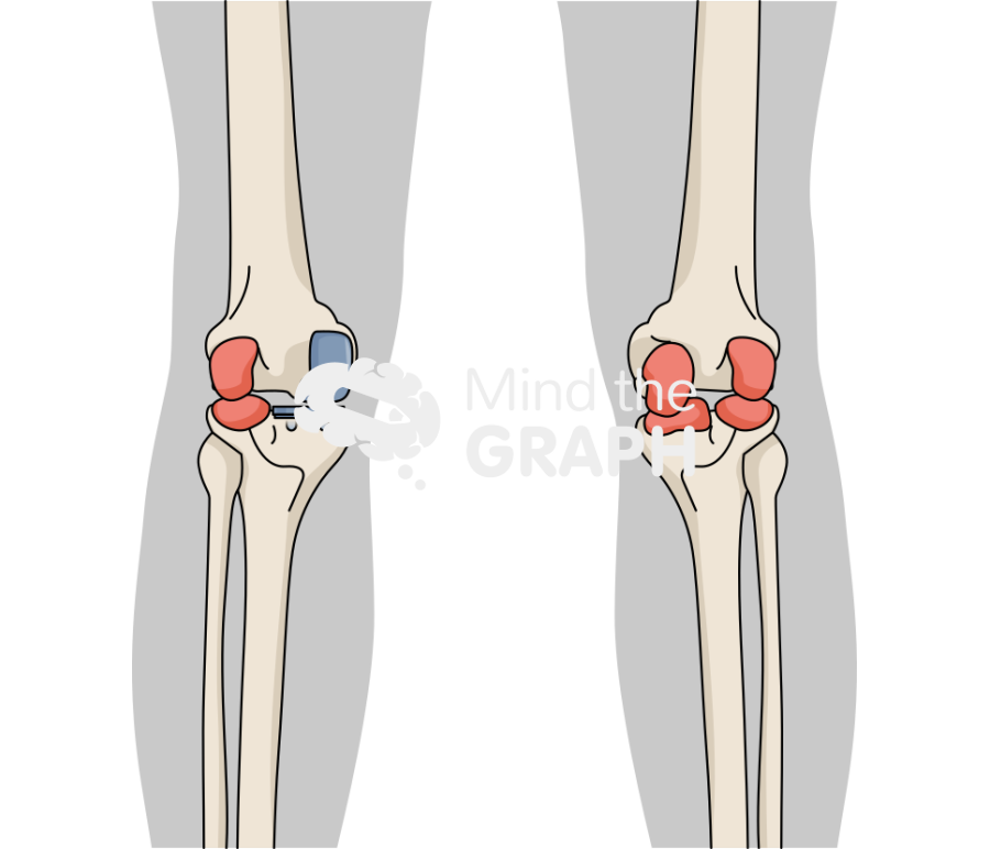 Medial unicondylar knee arthroplasty fixed bearing anterior posterior body Icons, Symbols, Pictures, and Images