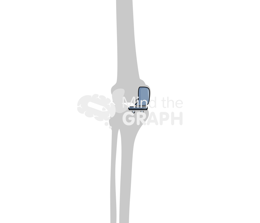 Medial unicondylar knee arthroplasty fixed bearing anterior posterior bone Icons, Symbols, Pictures, and Images