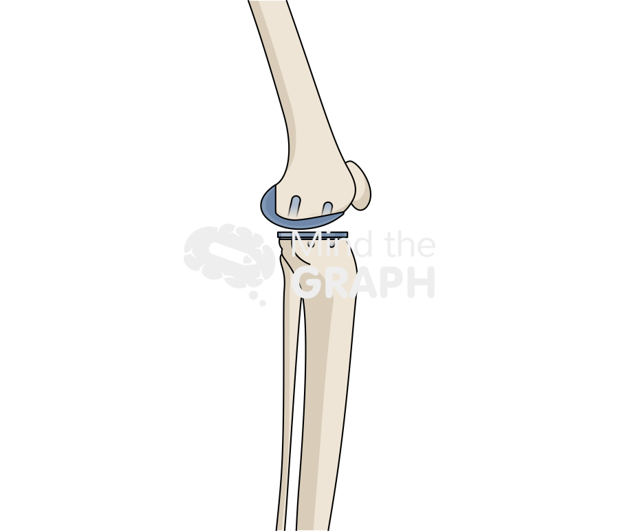 Medial unicondylar knee arthroplasty fixed bearing lateral bone full Icons, Symbols, Pictures, and Images