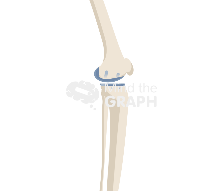 Medial unicondylar knee arthroplasty fixed bearing lateral bone full Icons, Symbols, Pictures, and Images