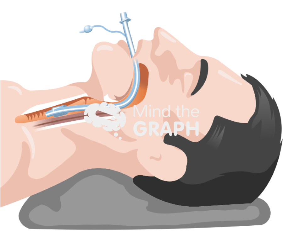 Men intubation detailed Icons, Symbols, Pictures, and Images
