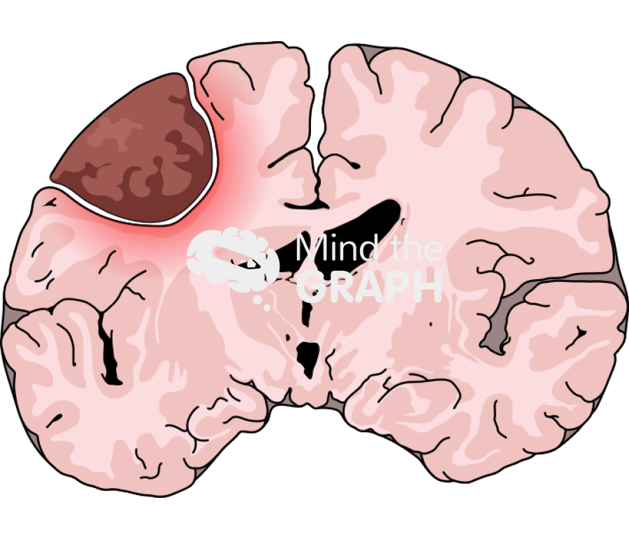 Meningioma brain frontal cut Icons, Symbols, Pictures, and Images