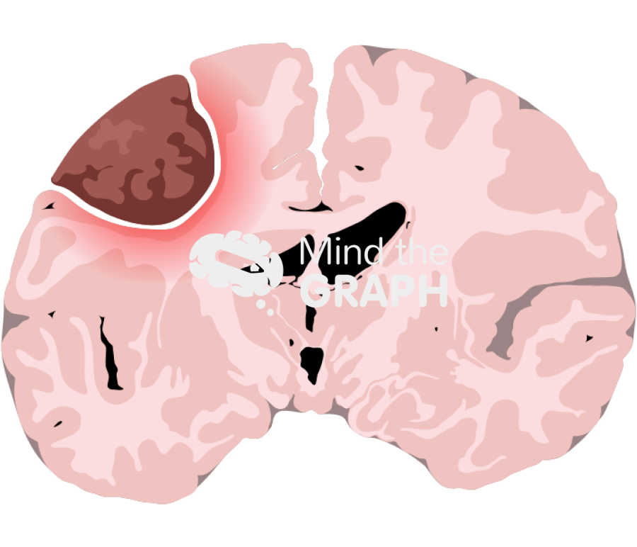 Meningioma brain frontal cut Icons, Symbols, Pictures, and Images