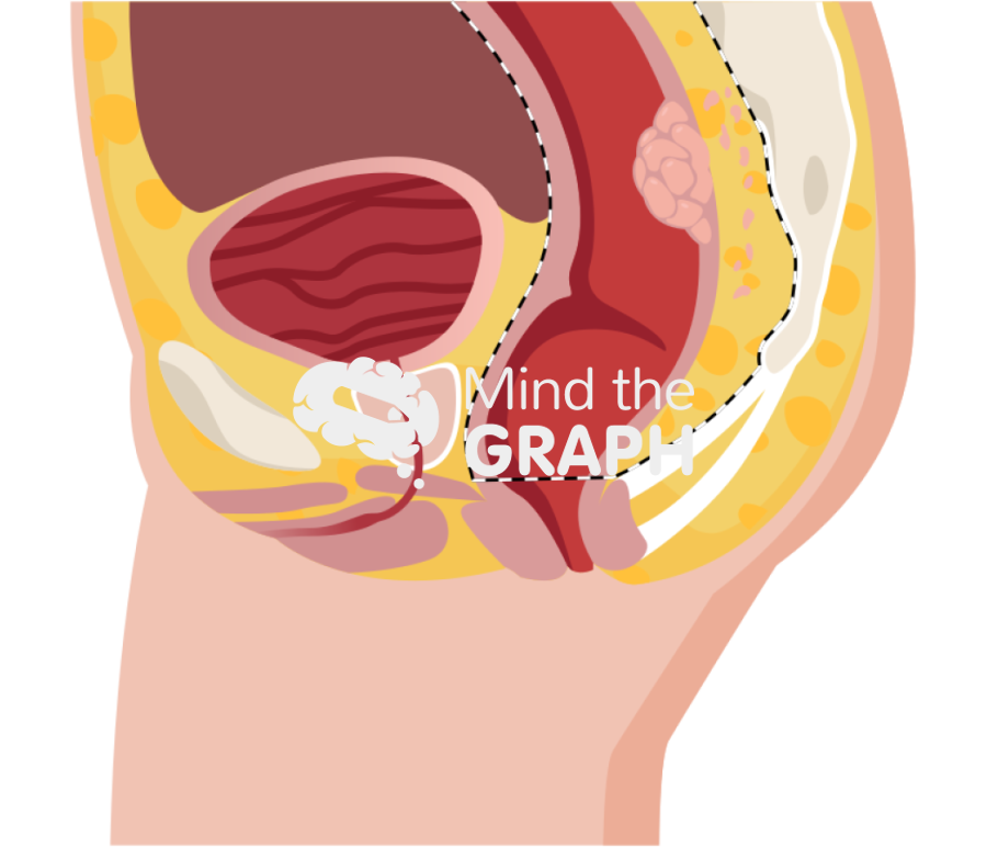 Mesorectal excision Icons, Symbols, Pictures, and Images