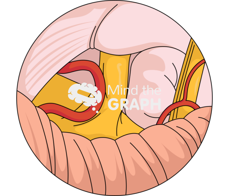 Microvascular decompression trigeminal neuralgia zoom 1 Icons, Symbols, Pictures, and Images