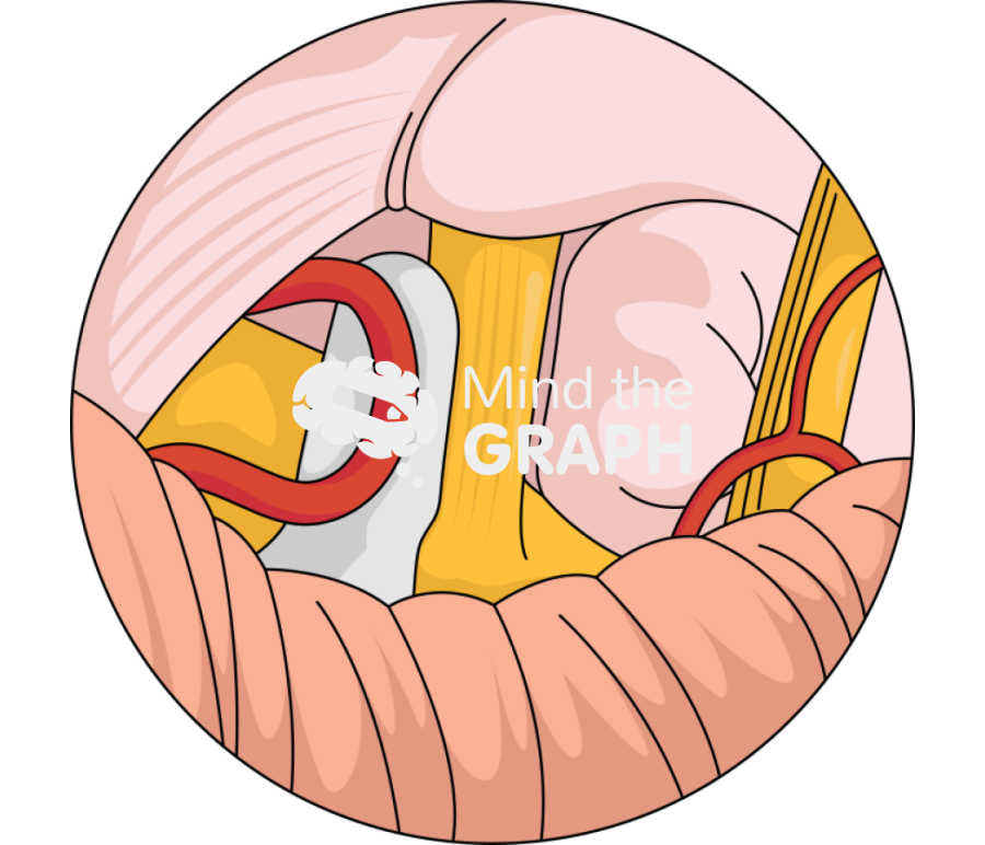 Microvascular decompression trigeminal neuralgia zoom 2 Icons, Symbols, Pictures, and Images