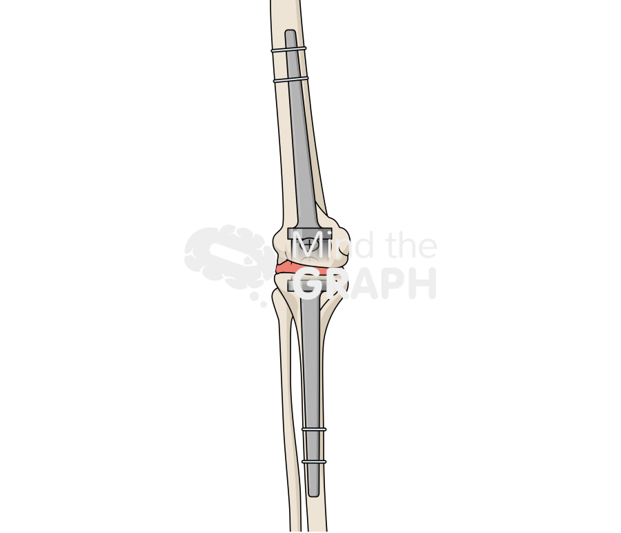 Modular knee arthrodesis Icons, Symbols, Pictures, and Images