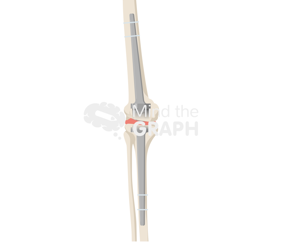 Modular knee arthrodesis Icons, Symbols, Pictures, and Images