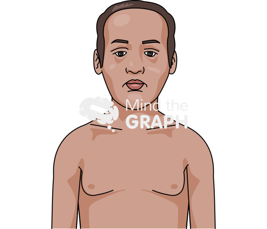 Myotonic dystrophy symptom man tanned frontal Icons, Symbols, Pictures, and Images
