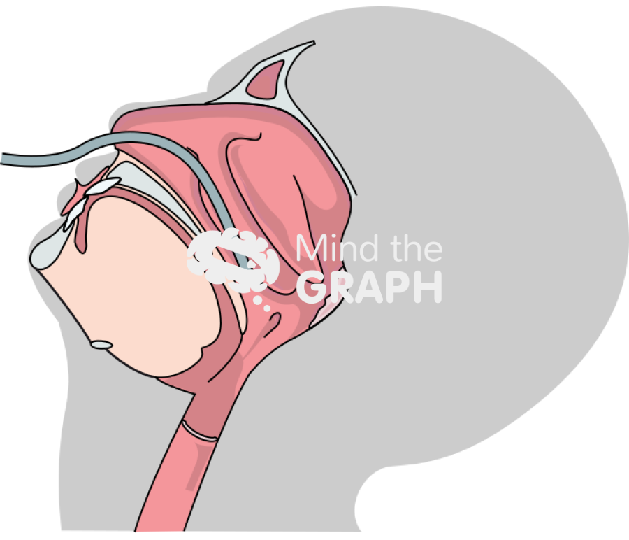 Nasopharyngeal swab collection 1 Icons, Symbols, Pictures, and Images