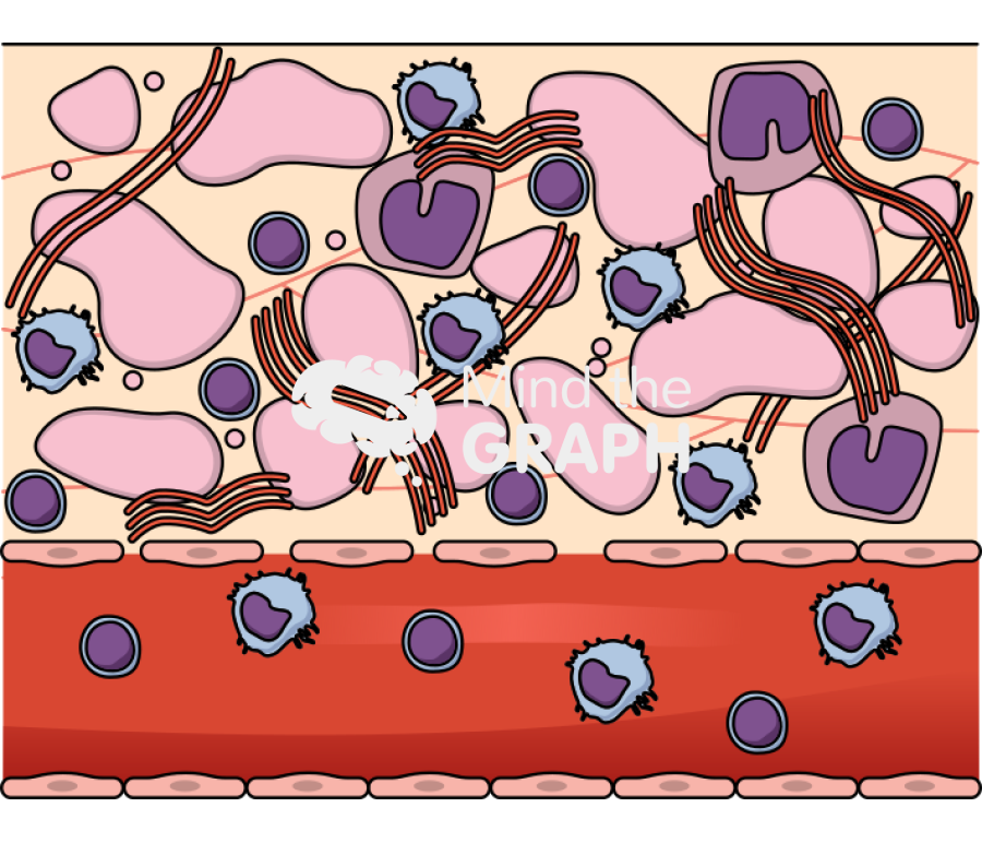 Nephrotic syndrome renal tissue Icons, Symbols, Pictures, and Images