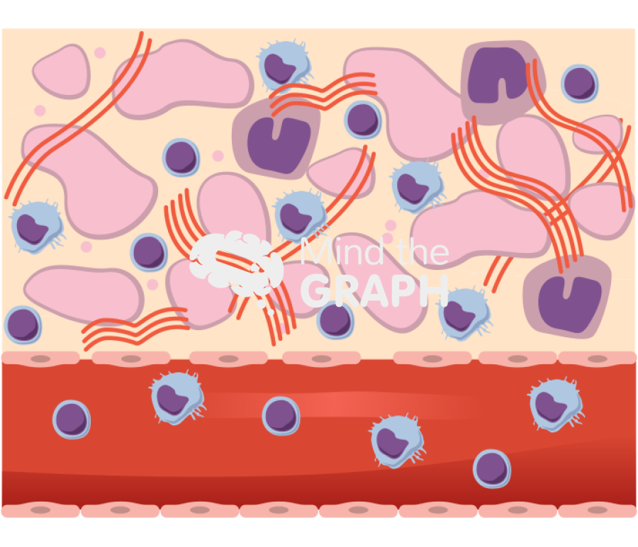 Nephrotic syndrome renal tissue Icons, Symbols, Pictures, and Images