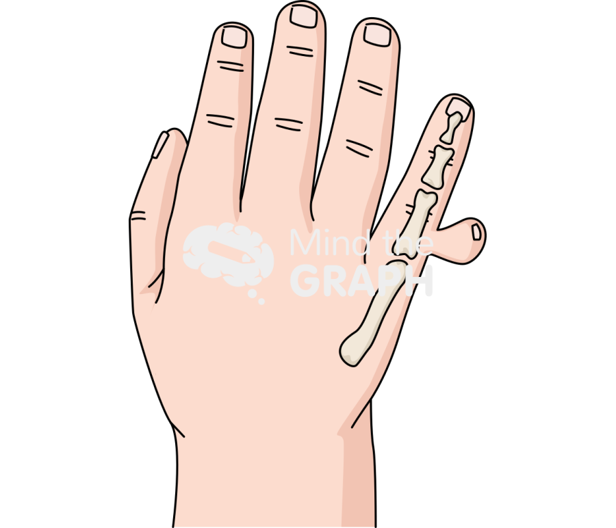 Newborn hand polydactyly postaxial 2 Icons, Symbols, Pictures, and Images