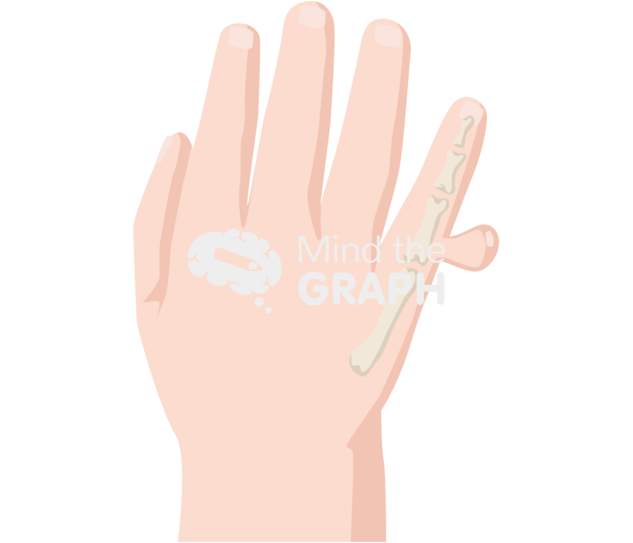 Newborn hand polydactyly postaxial 2 Icons, Symbols, Pictures, and Images