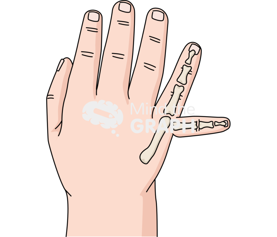 Newborn hand polydactyly postaxial 4 Icons, Symbols, Pictures, and Images