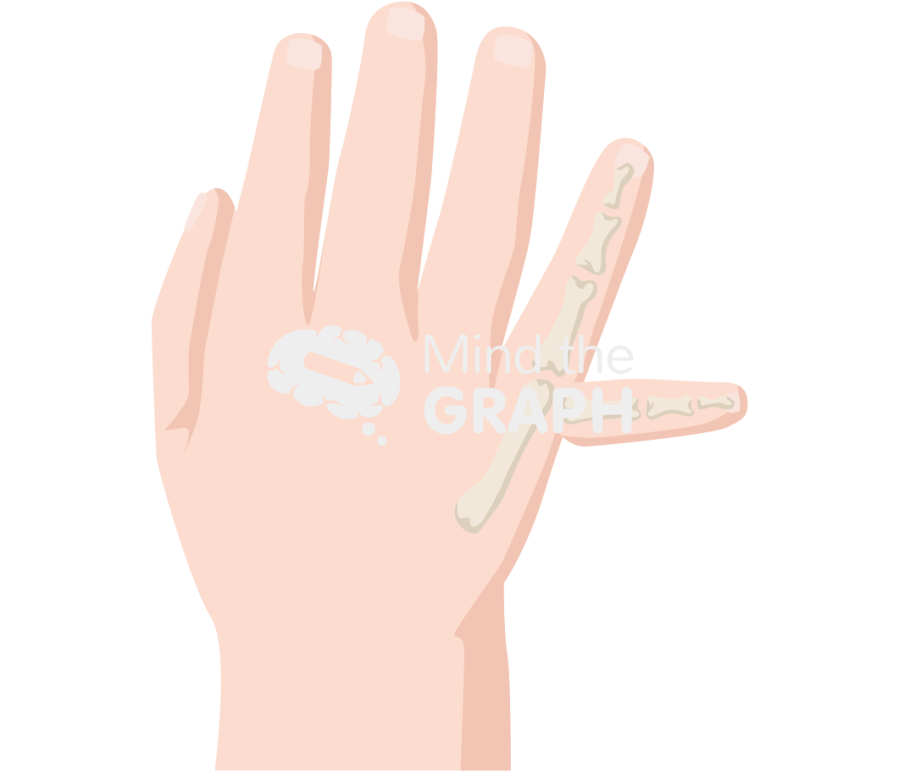 Newborn hand polydactyly postaxial 4 Icons, Symbols, Pictures, and Images