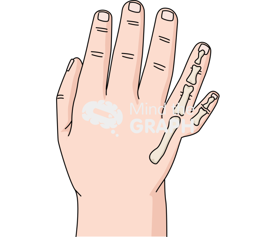 Newborn hand polydactyly postaxial 5 Icons, Symbols, Pictures, and Images