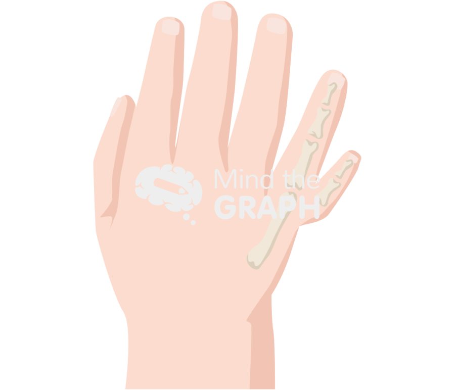 Newborn hand polydactyly postaxial 5 Icons, Symbols, Pictures, and Images