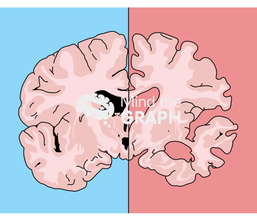 Normal and alzheimer brain front cut Icons, Symbols, Pictures, and Images