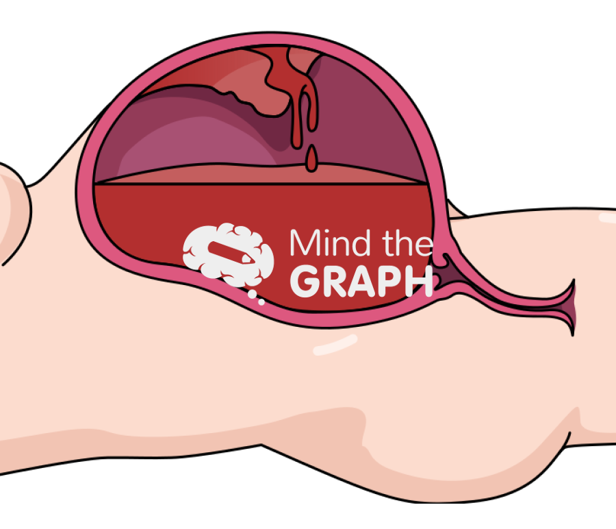 Obstetric hemorrhage cut lateral Icons, Symbols, Pictures, and Images