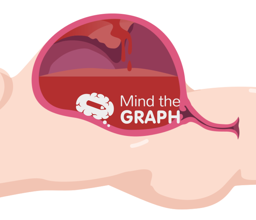 Obstetric hemorrhage cut lateral Icons, Symbols, Pictures, and Images