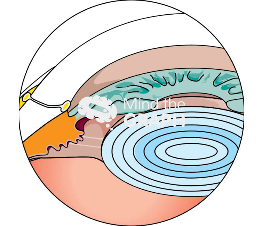Open angle glaucoma Icons, Symbols, Pictures, and Images
