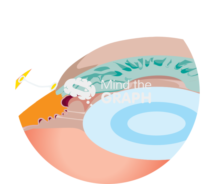 Open angle glaucoma Icons, Symbols, Pictures, and Images
