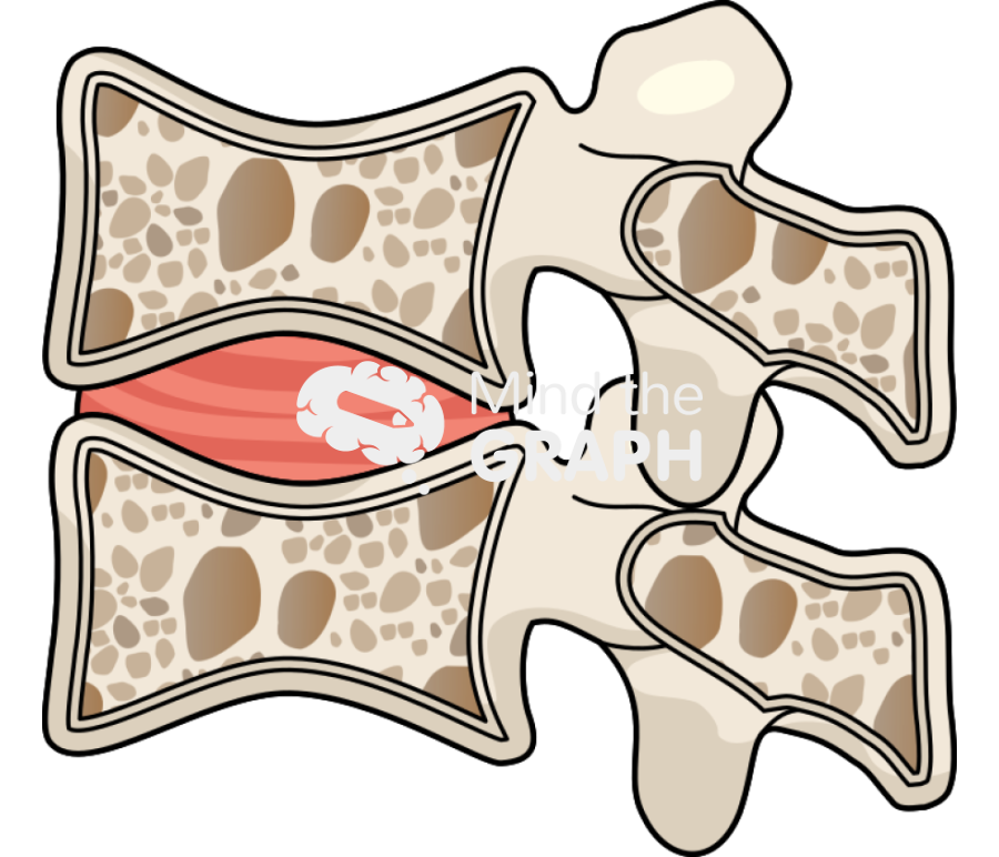 Osteoporotic vertebra Icons, Symbols, Pictures, and Images