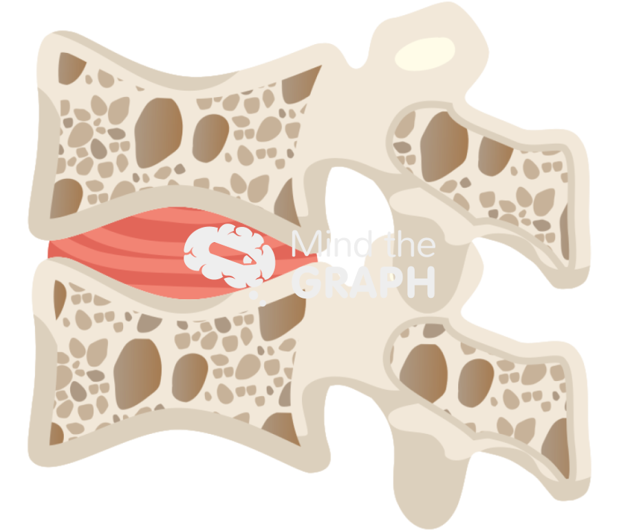Osteoporotic vertebra Icons, Symbols, Pictures, and Images